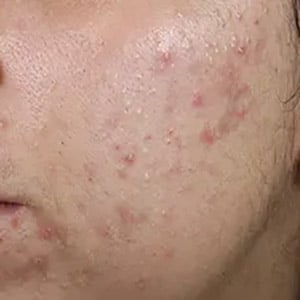 acne 3 before
