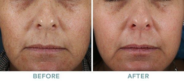 Brightening Peel Level 2 Chemical Peel Before After 01 061020 2
