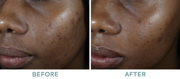Chemical Peel ViPeel Before After 03