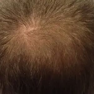 hair loss 2 after