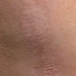 microneedling fraxel scars 1 after