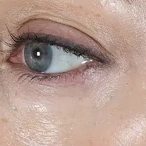 wrinkle relaxers botox eyes 1 after